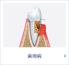 歯周病