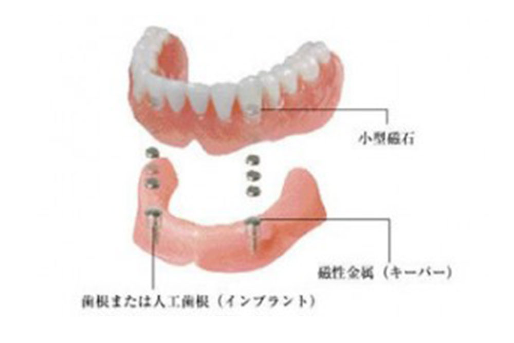 磁性マグネットデンチャー
