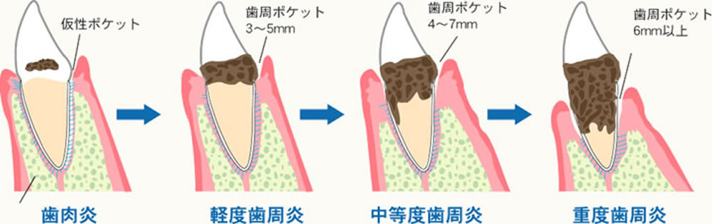 歯周病の進行度
