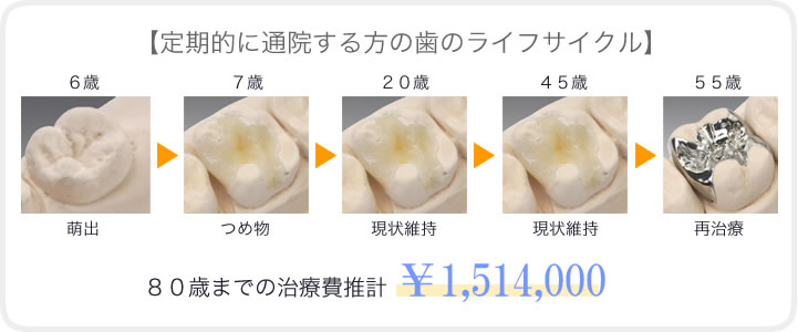 予防を習慣にしている人の生涯治療費と歯の寿命